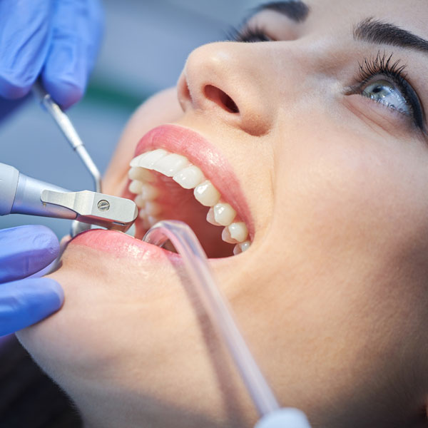 Dental Deep Cleaning - Dentist in Orange CA - Restoration Dental