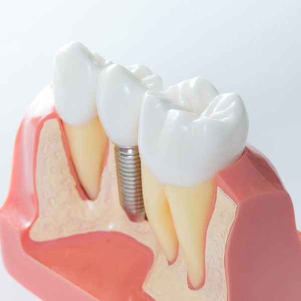 Dental Implants in Orange California - Restoration Dental