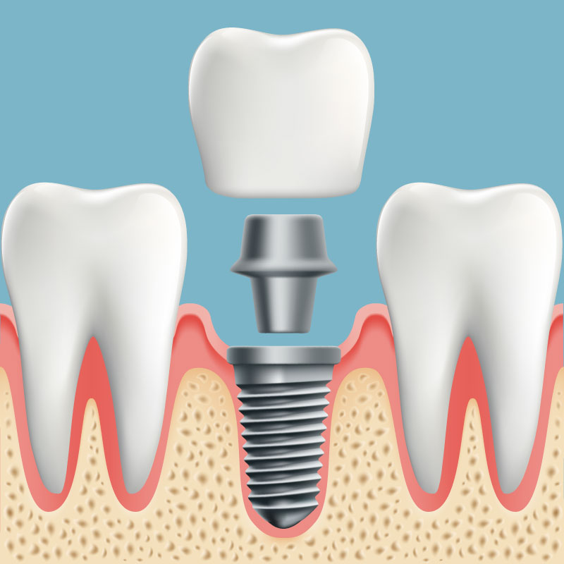 Dental Implant Orange CA - Dr Pham is a dental implant specialist in Orange County CA