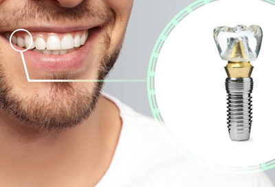 How Long Do Dental Implants Last