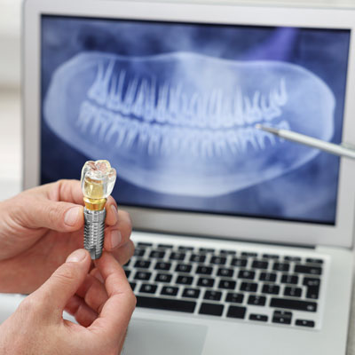 Gold material in dental implants