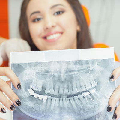 What do dental implants look like