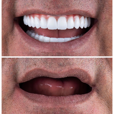 Before and After the Dental Implant for Marco T.