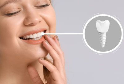 How-Long-Do-Mini-Dental-Implants-Last-1