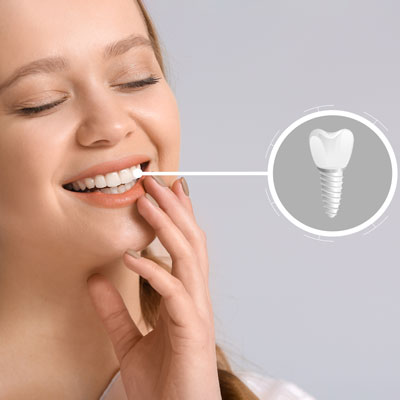 How-Long-Do-Mini-Dental-Implants-Last-1