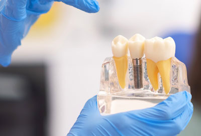 What Not to Do After Dental Implants