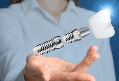 Why Do Dental Implants Cost So Much