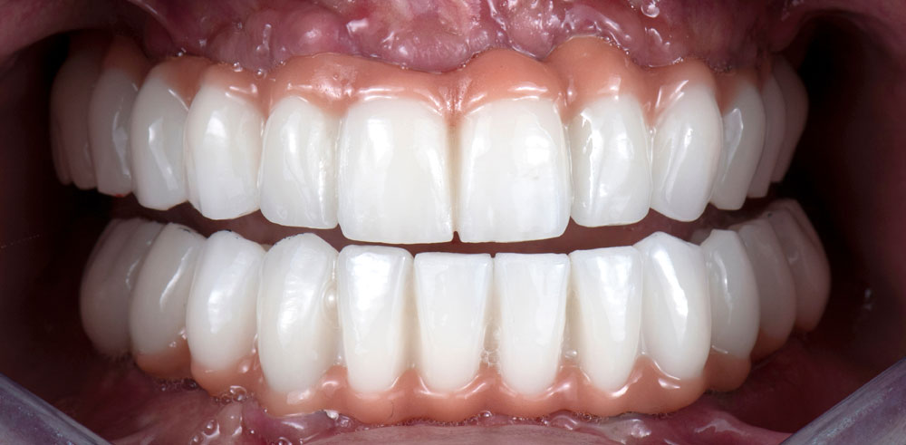 Dental Implant Before / After - Restoration Dental in Orange CA