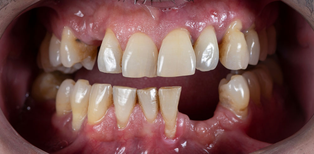 Dental Implant Before / After - Restoration Dental in Orange CA