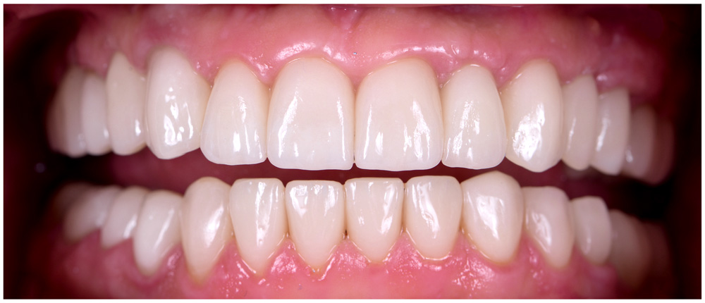 Dental Implant: After Care - Restoration Dental in Orange CA