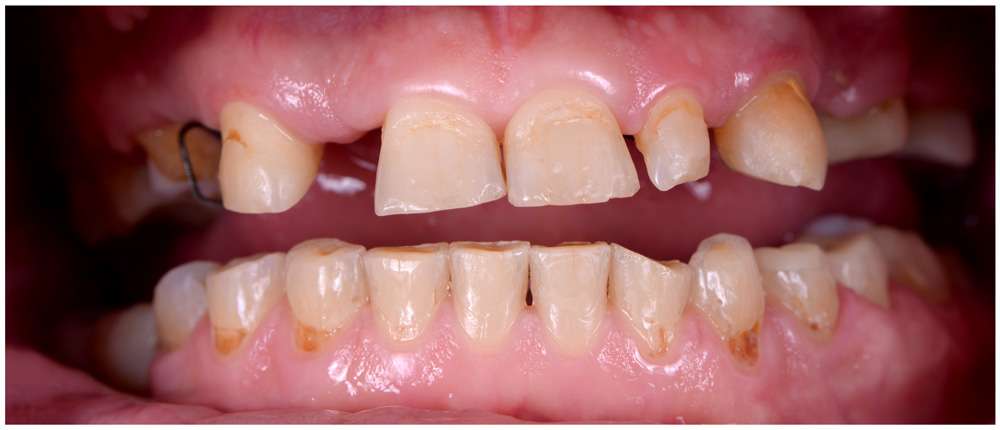 Dental Implant: Before Care - Restoration Dental in Orange CA