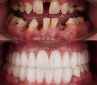 All on 4 zirconia teeth before and after.
