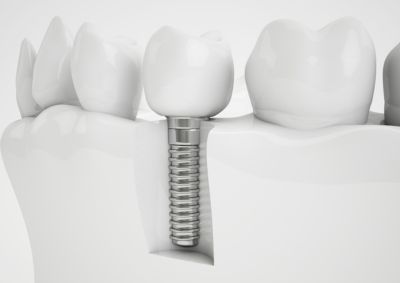 Are dental implants permanent ?