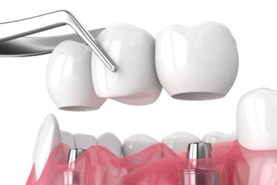 Dental bridges is an alternative to dental implants
