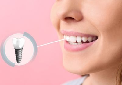 Dental implants with customized crowns for a natural smile