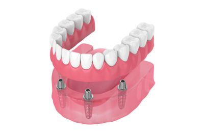 Full dentures are an alternative to dental implants