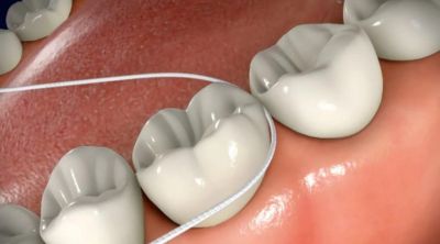 How do you clean under all 4 dental implants