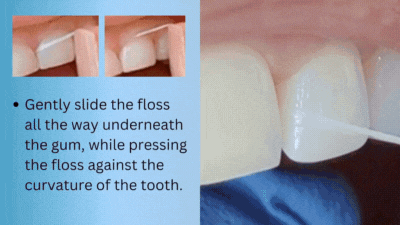 Step-By-Step Flossing Technique
