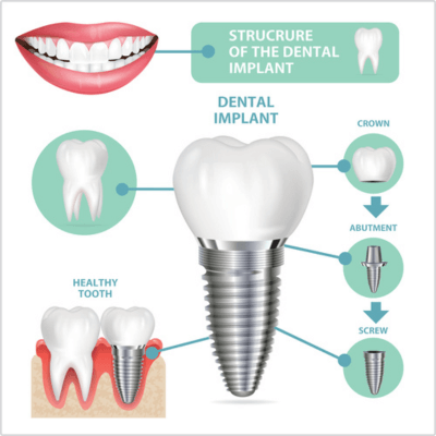 The Structure And Components Of Dental Implants