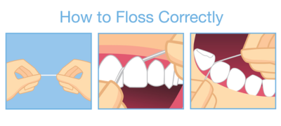 What you should know when flossing dental implants