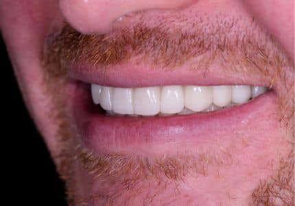 Case studies 4 images after dental implants