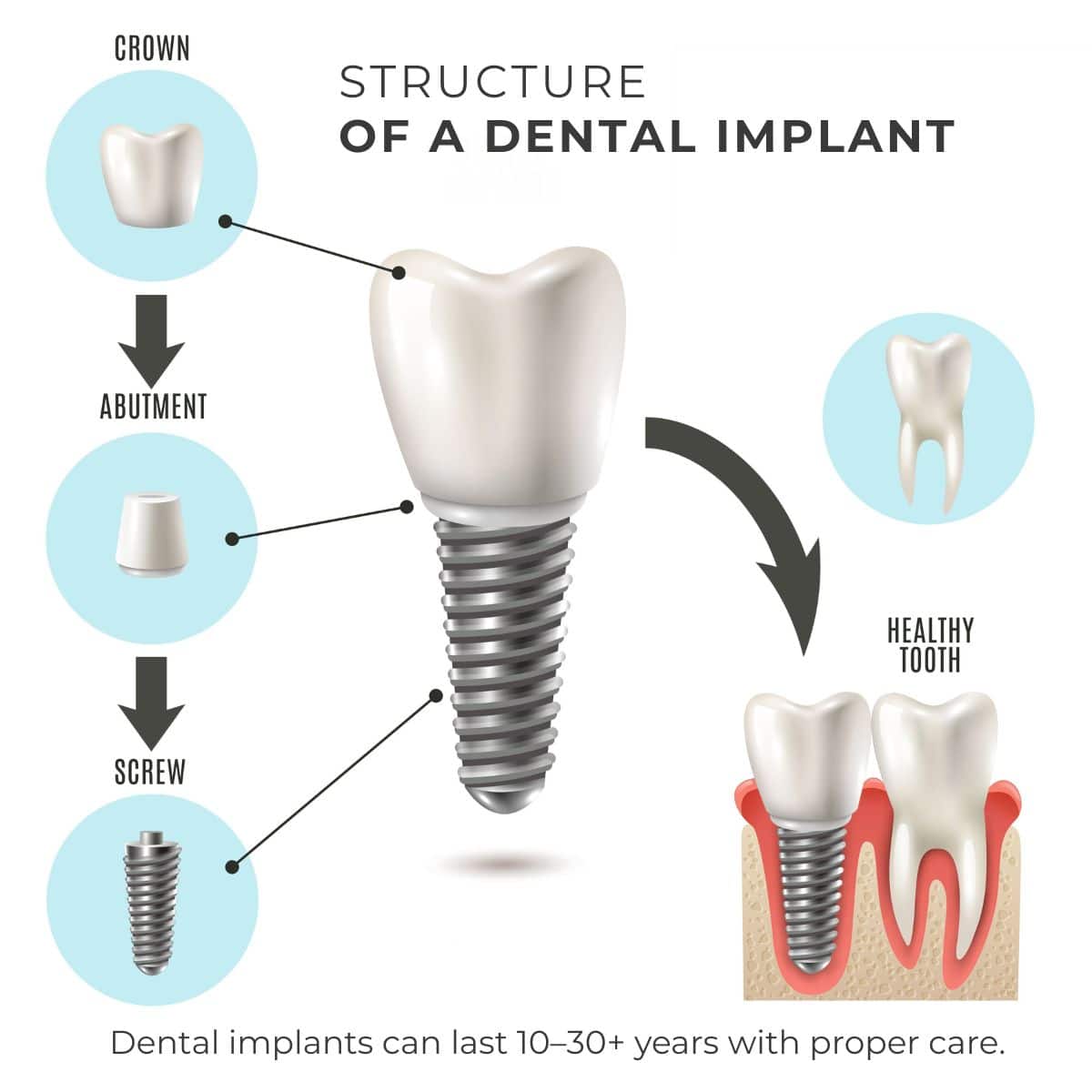 Illustration showing the structure of a dental implant—including crown, abutment, and screw—highlighting its durability and long-term lifespan of 10 to 30 years with proper care.