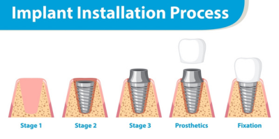 Dental implant stages