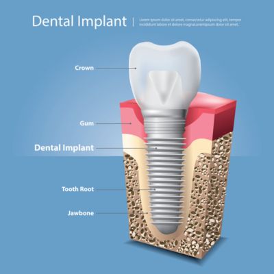 Dental Implants Structure