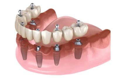 How long after full dental implants can I eat normally