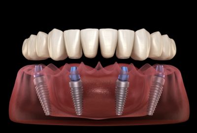 How Long Does It Take to Get Used to All-on-4 Dental Implants?