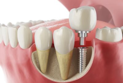 Is it ever too late to get a dental implant