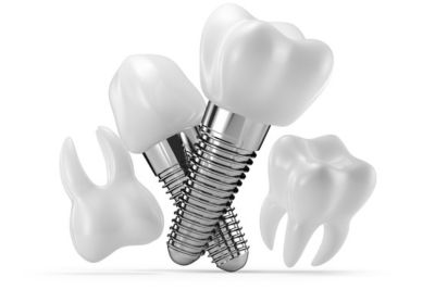 Natural look of dental implants