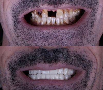 Patient 2 after when surgery All-on-4 implants at Restoration Dental OC, Image before and after
