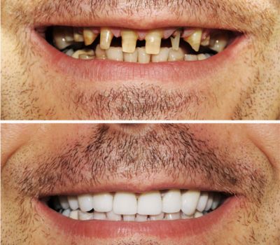 Patient 3 after when surgery All-on-4 implants at Restoration Dental OC, Image before and after