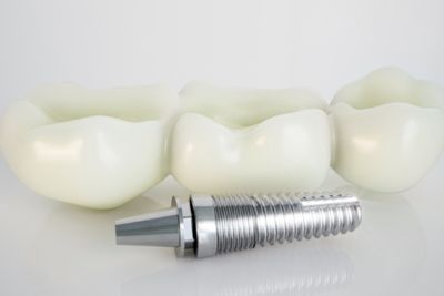 Permanent durability of dental implants