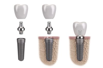 Pros and cons of dental implants