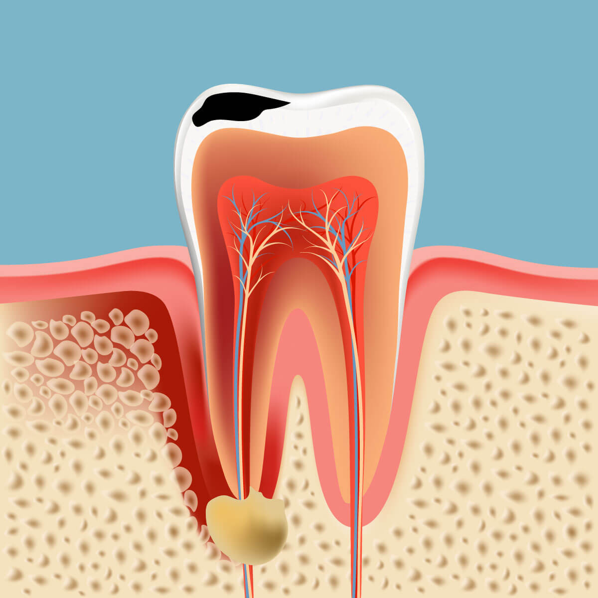 Root canal treatment in Orange ca