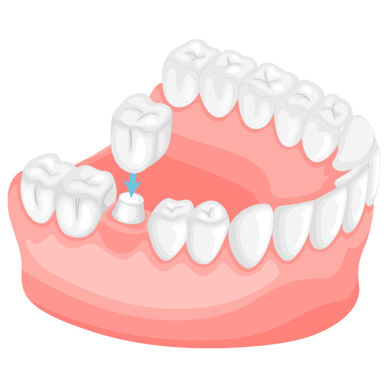 Dental Crowns Orange CA - Dr Ronald Pham is an expert in dental crowns