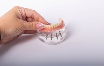What is the recovery time for the all-on-4 dental