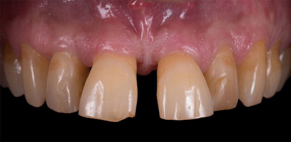 Dental Veneers in Orange CA - Restoration Dental - Before and After Photos