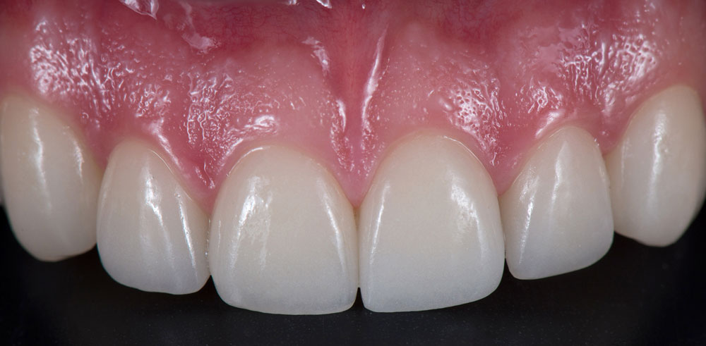 Dental Veneers in Orange CA - Restoration Dental - Before and After Photos