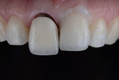 How to change color of dental crown