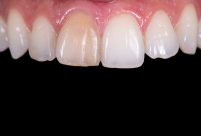 Crown Discoloration