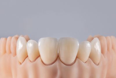 crowns enhance your smile’s aesthetics