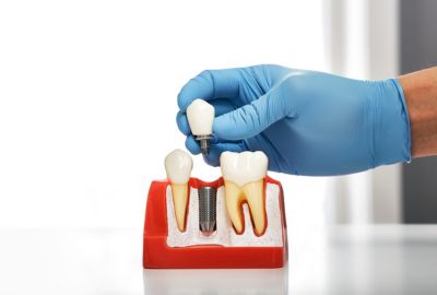 Type Crowns On Dental Implants