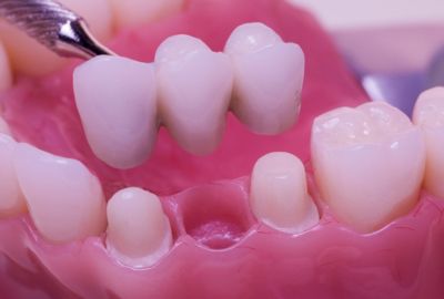 Dental bridges alternative treatments to crowns