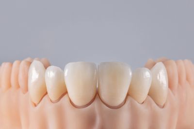 Dental crowns a subtle lighter shade