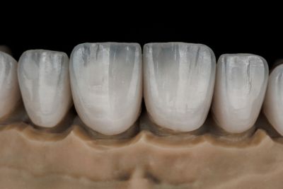 Dental Crowns matching your natural teeth