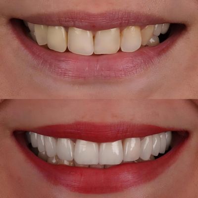 Can a dentist improve the color of my dental crowns?