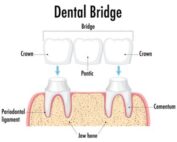 Difference between crowns and bridges